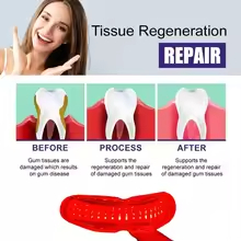 Teeth Whitening Laser Treatment - Laser Treatment for Periodontal Disease -
