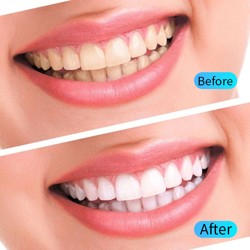 Teeth Whitening Gel Kit Oral H – обзор и цена Teeth Whitening Opalescence