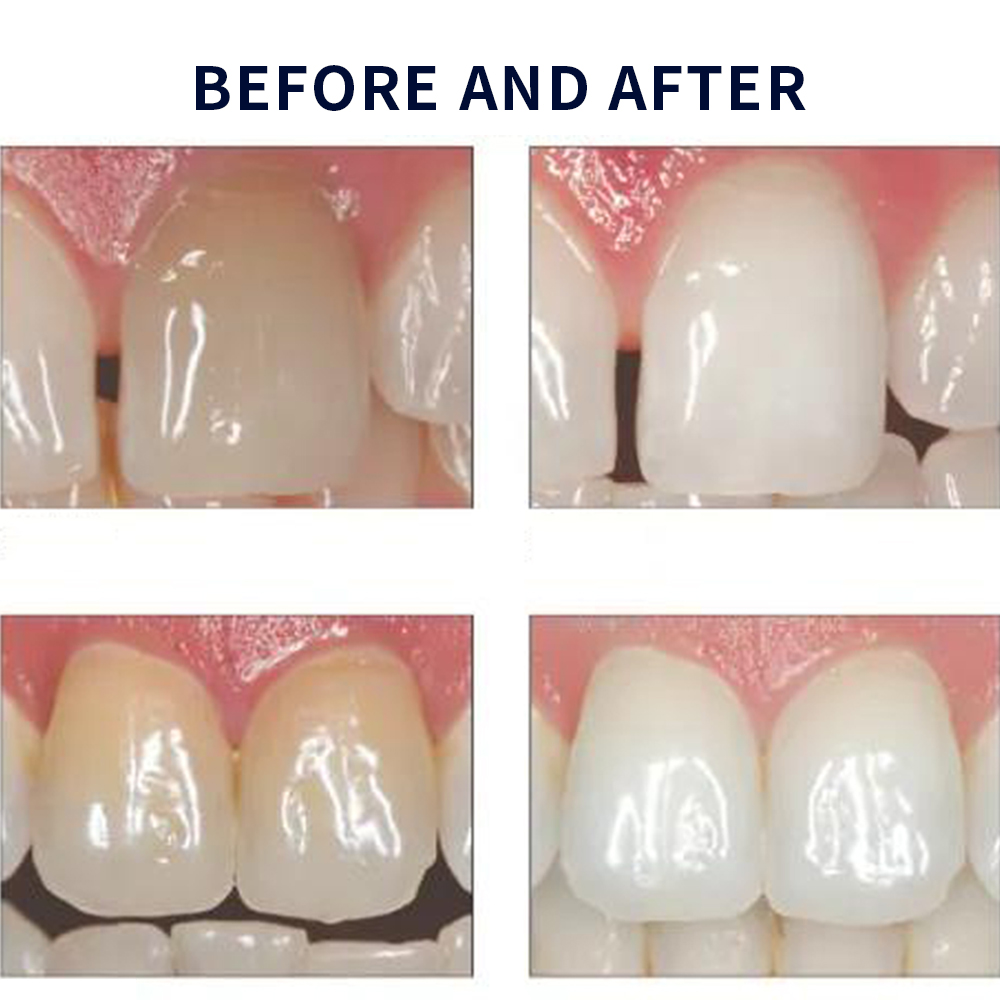 Opalescence Whitening 20% PF 2 – обзор и цена Teeth Whitening Opalescence