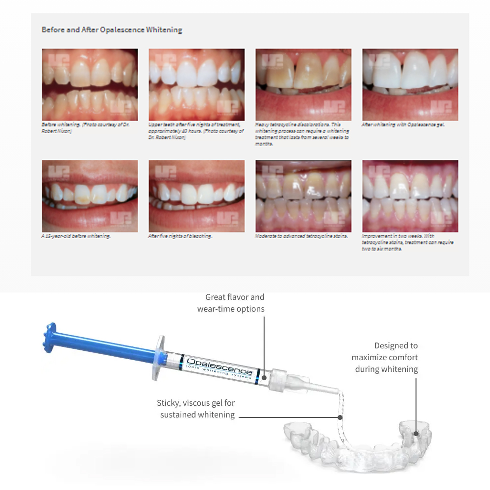 Opalescence Whitening 20% PF 2 – обзор и цена Teeth Whitening Opalescence