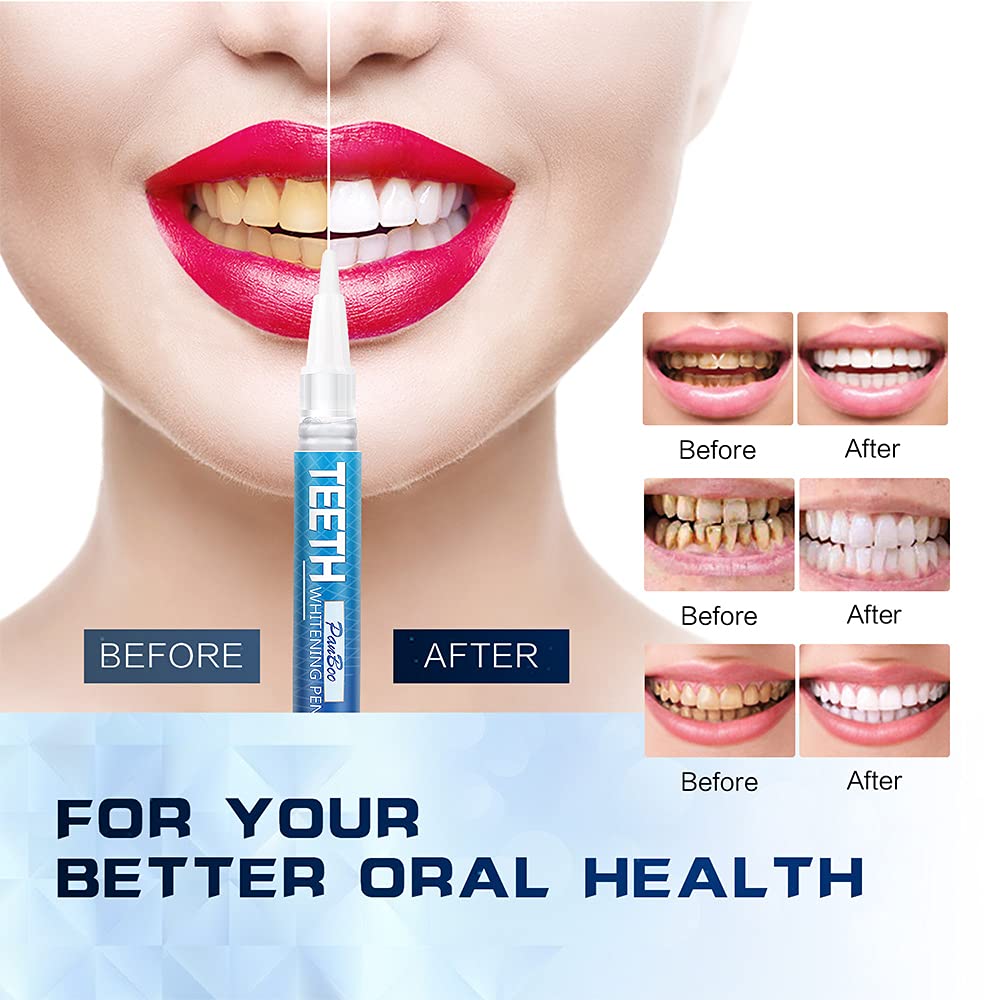 Teeth Whitening Pen Remove Cof – обзор и цена Teeth Whitening Opalescence
