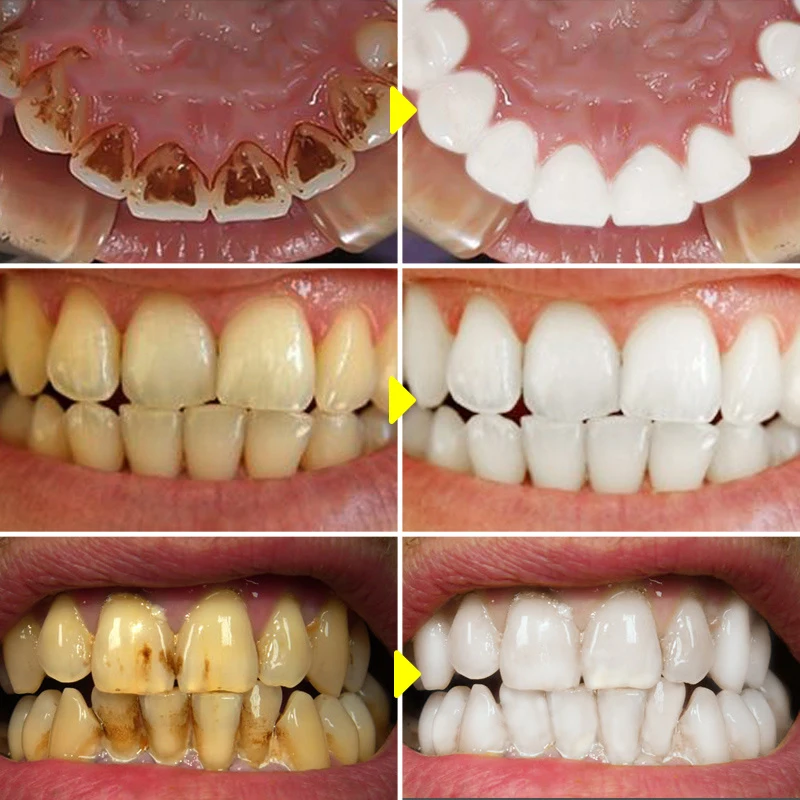V34 Teeth Whitening Mousse Too – обзор и цена Teeth Whitening Mousse