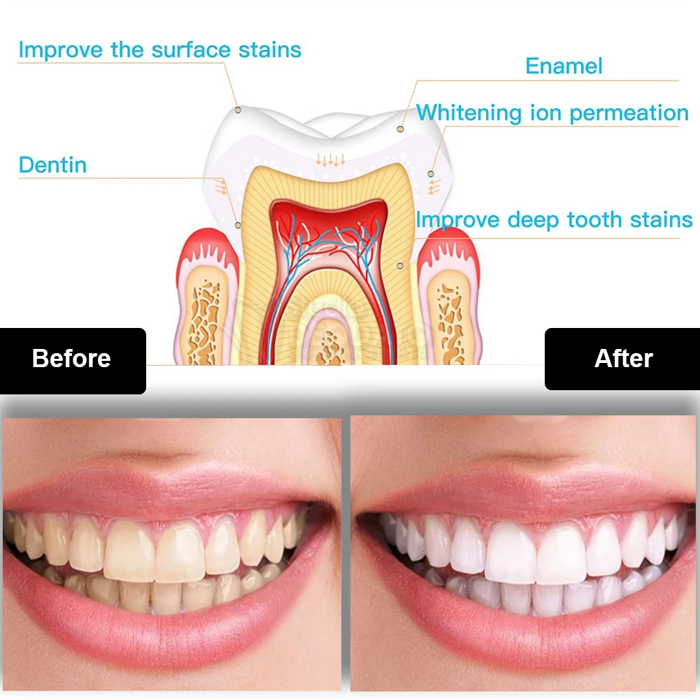 Dental Teeth Whitening Kit Min – обзор и цена Teeth Whitening Blue Light