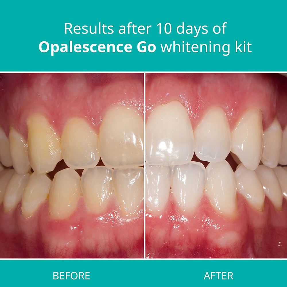 Opalescence Go Teeth Whitening – обзор и цена Teeth Whitening Opalescence