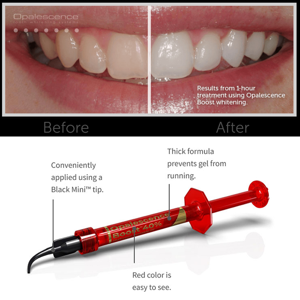 Ultradent Opalescence Boost PF – обзор и цена Teeth Whitening Opalescence