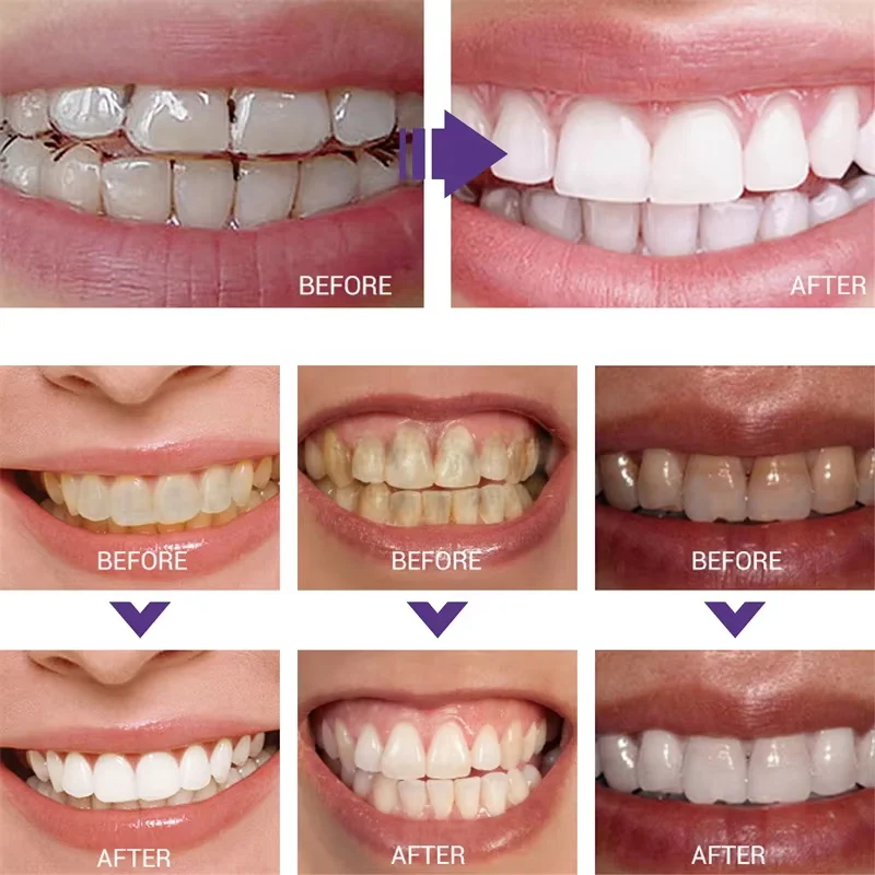 Whitening Toothpaste Teeth Cle – обзор и цена Teeth Whitening Korea